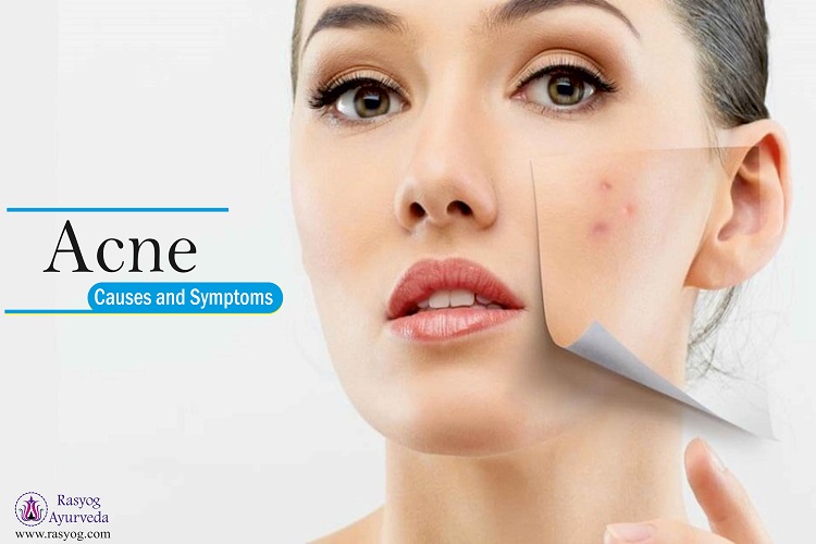 acne causes and symptoms