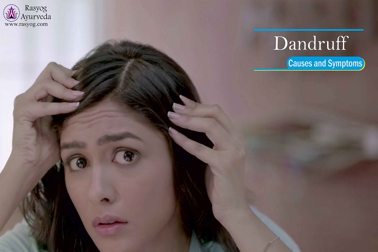 dandruff causes and symptoms