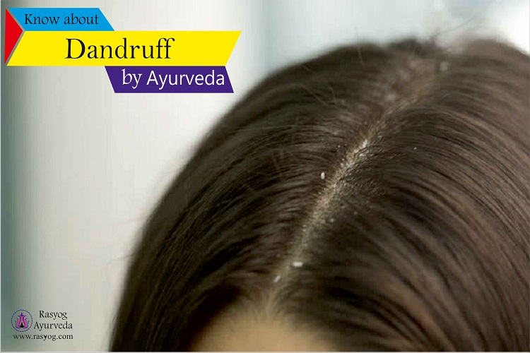 dandruff cure and medicine