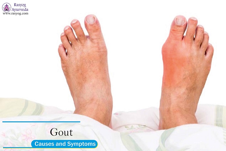 gout causes and symptoms