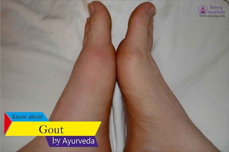 gout cure and medicine