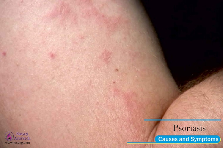 psoriasis causes and symptoms